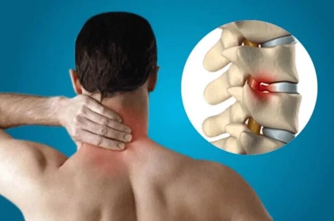 Osteohondroza hrbtenice