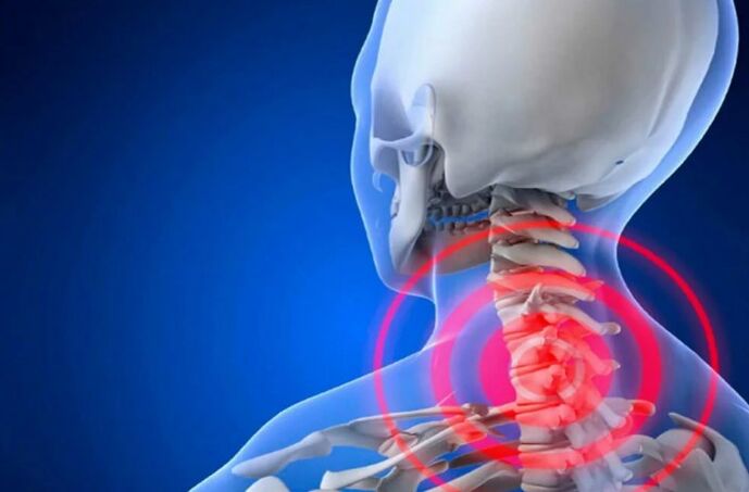 Osteohondroza vratne hrbtenice