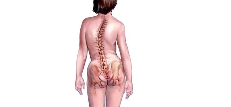 Osteohondroza