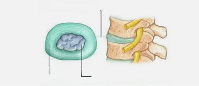 Narava osteohondroze