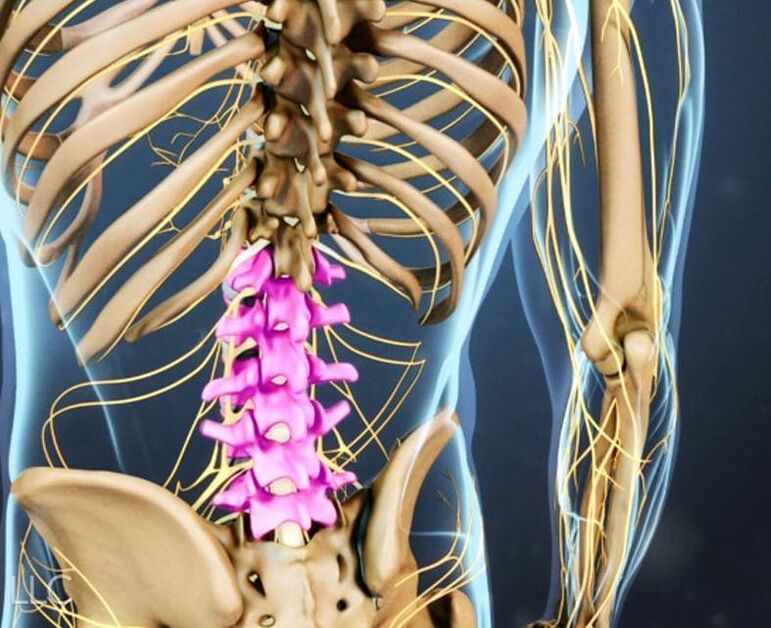 Osteohondroza ledvene hrbtenice