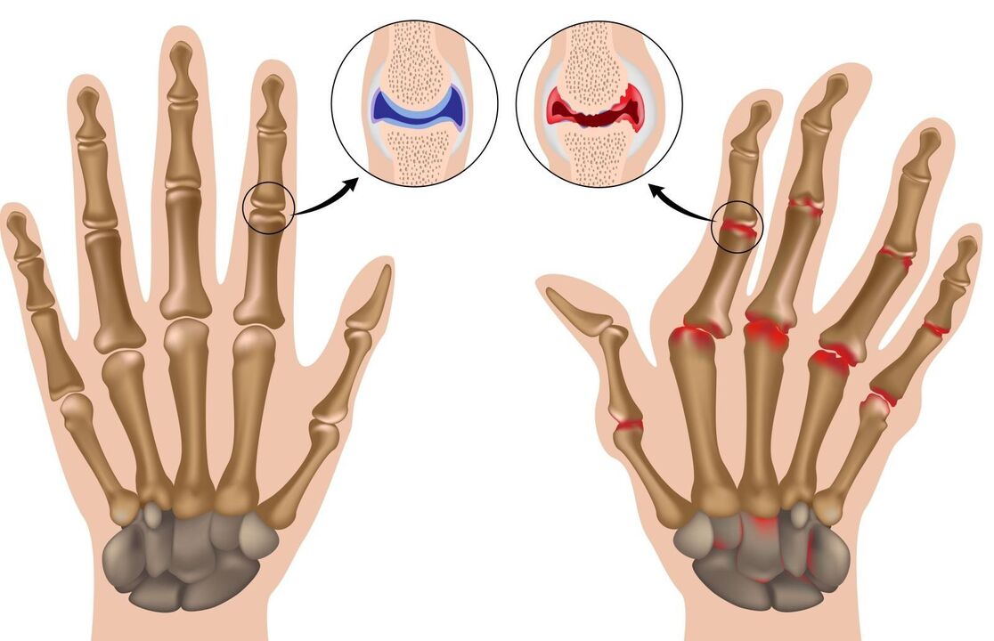 revmatoidni artritis